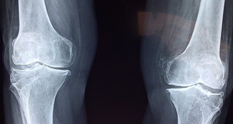 x ray of knees